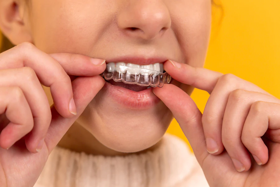 Porcelain veneers